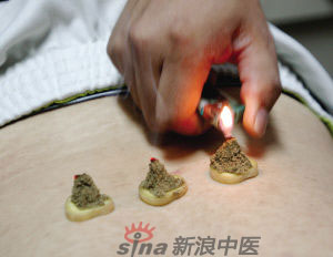 灸法的種類  你知道多少？